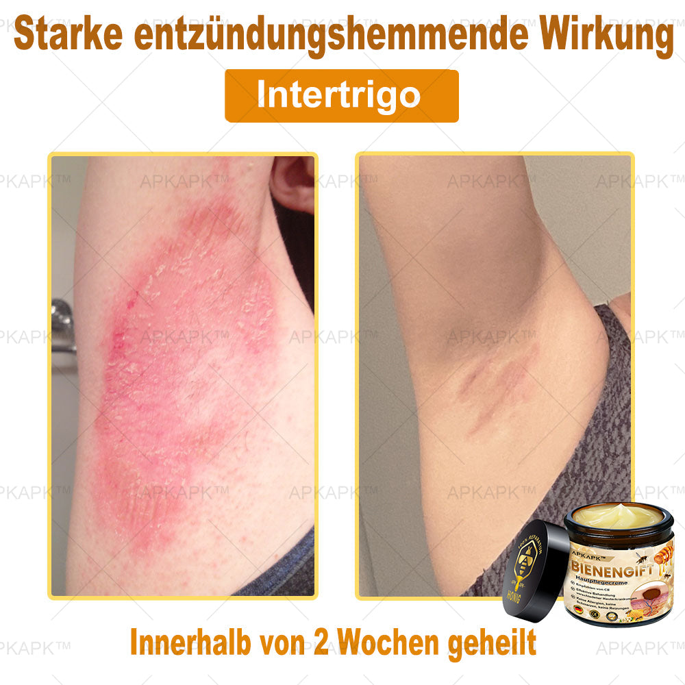 Hautgeprüfte Zertifizierung | 🥇🥇 APKAPK™ BIENENGIFT Hautpflegecreme ( 🔥Letzter Tag der Aktion 80% Rabatt)