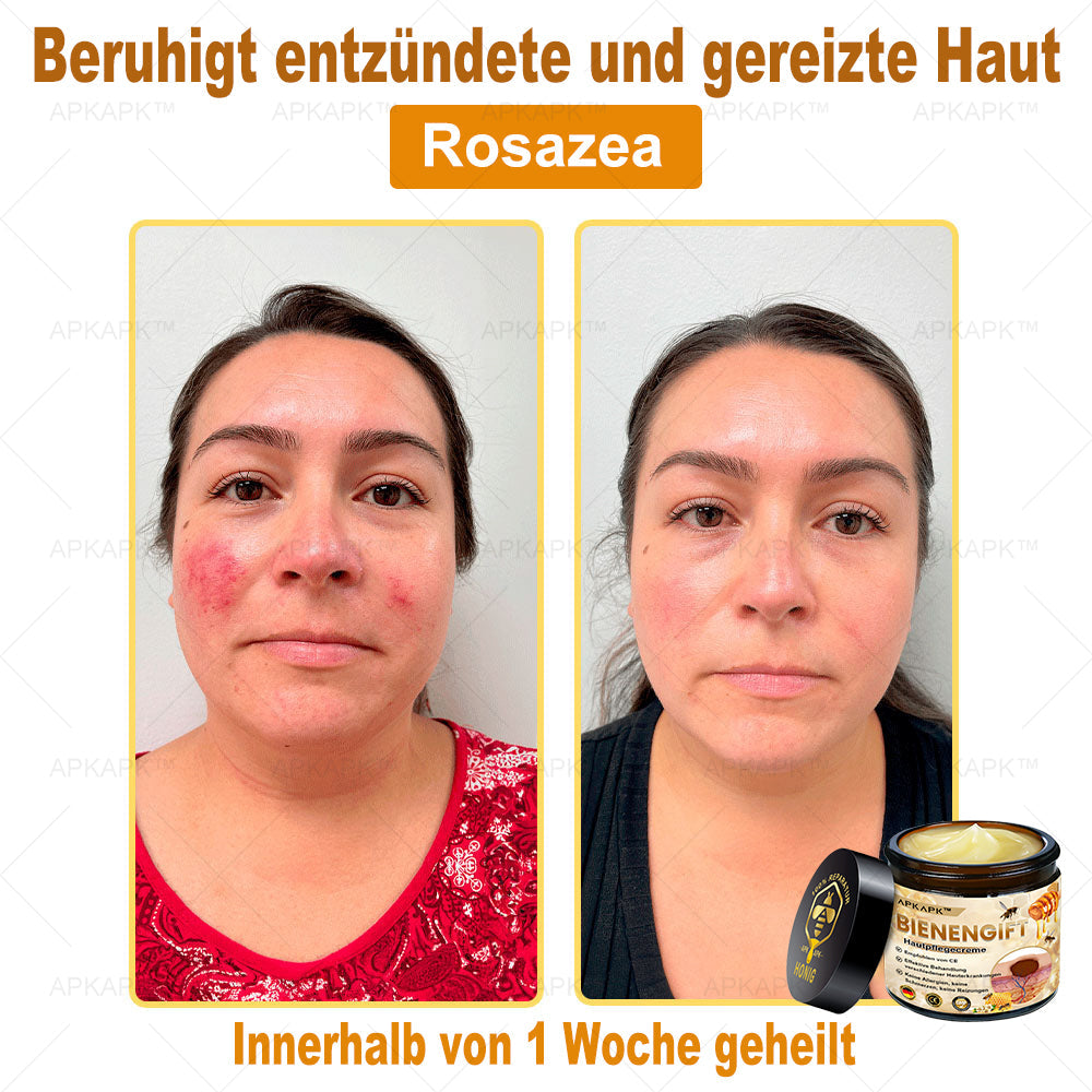 Hautgeprüfte Zertifizierung | 🥇🥇 APKAPK™ BIENENGIFT Hautpflegecreme ( 🔥Letzter Tag der Aktion 80% Rabatt)